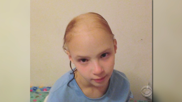 11-year-old Eliana Lawrence seen after using shampoo that thinned her hair. Courtesy: CBS NEWS